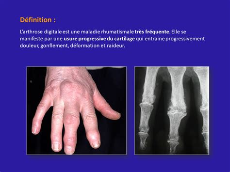 Arthrose Doigt 2 Rééducation Kinesithérapie Orthese Denis Gerlac Rééducation Et Orthèses De