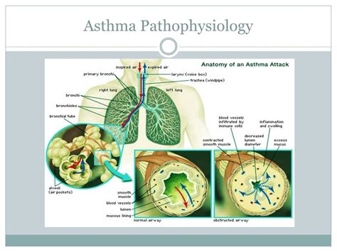 Ppt Asthma Powerpoint Presentation Free Download Id2052046