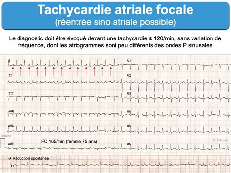 Tachycardie atriale par réentrée SA e cardiogram