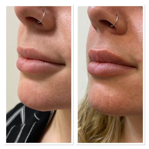Botox Lip Flip Before And After No Filler Rplasticsurgery