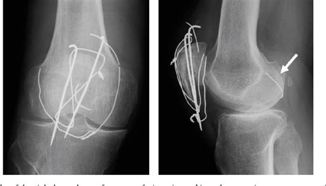 Arthroscopic Removal of a Wire Fragment from the Posterior ...