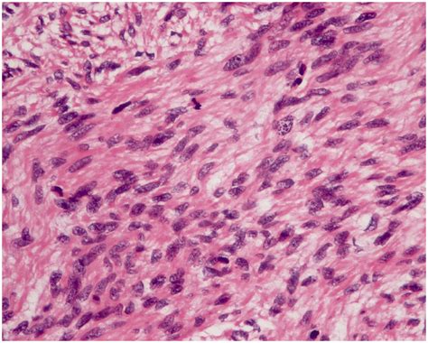 Uterine Leiomyosarcoma Cells With Severe Atypia And Mitotic Activity