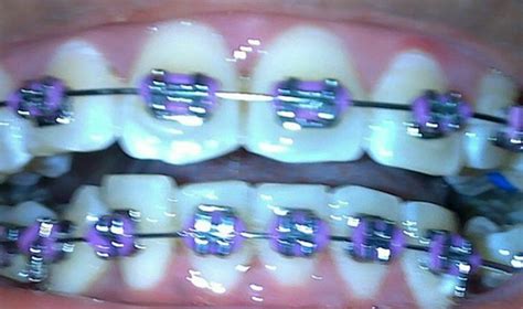 Cute Purple Braces For Teeth Teeth Braces Braces Colors Orthodontics Braces