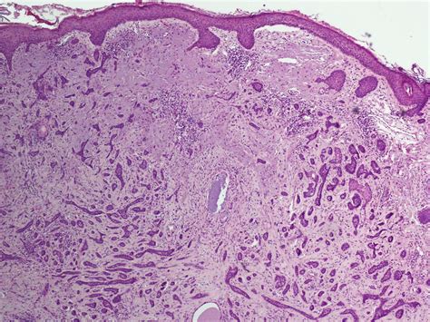 Basaalcelcarcinoom Bcc Basal Cell Carcinoma Ca Basocellulare