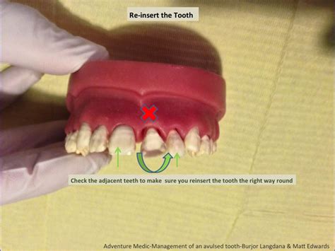 Am Guide To Dental Trauma Adventure Medic