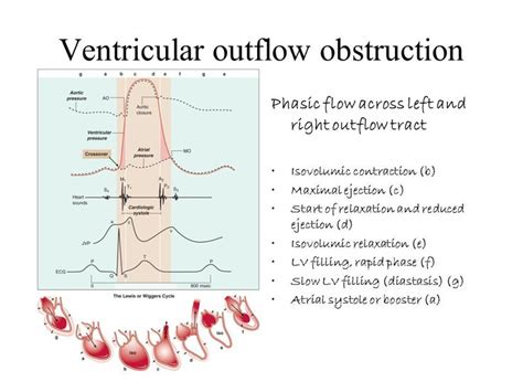 Right Ventricular Outflow Tract Anatomy