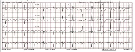 Rhythm Nation July Answer Cerebral T Waves And Other Neurogenic Ecg