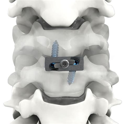 Cervical Interbody Fusion Cage Pro Link® Life Spine Anterior