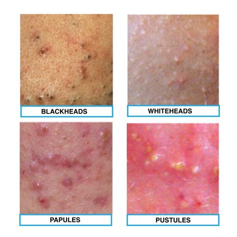 The Four Types Of Acne Blackheads Whiteheads Papule And Pustules Remember If You Have Any