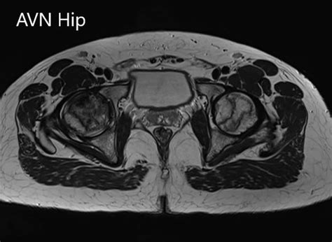 Case Study Bilateral Total Hip Replacement With Necrosis