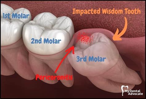 Impacted Wisdom Teeth How To Manage Symptoms