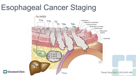 Esophageal Cancer Stages SexiezPix Web Porn