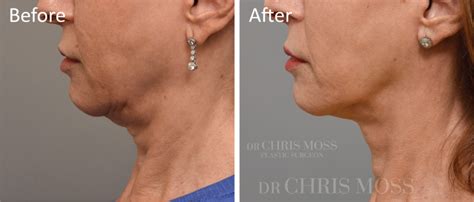 Neck Lift Before And After Results Dr Chris Moss Melbourne