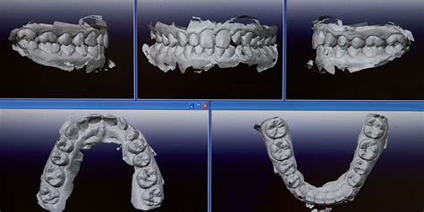 Digital Impressions Glassman Dental Care Uws Nyc