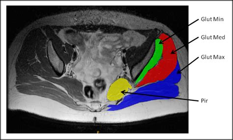 Pelvic Muscle Anatomy Mri