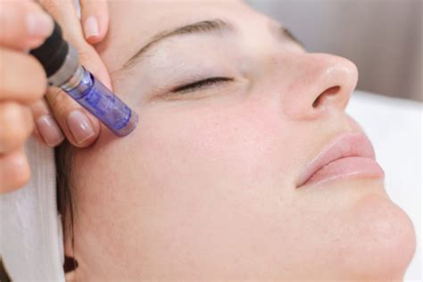 Repairing Skin Damage With The Micropen Treatment Vargas Face And