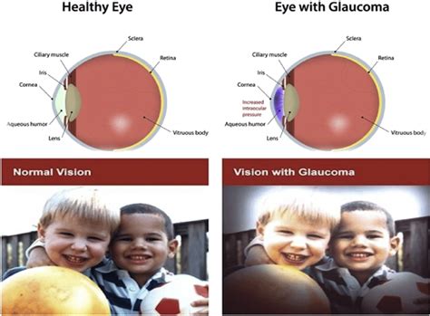 Glaucoma Vision Causes Of Vision Loss Worldwide — м Me Stardoll