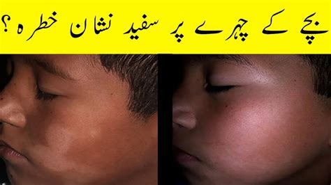 Pityriasis Alba Treatment In Urdu White Patches On Kids Face White