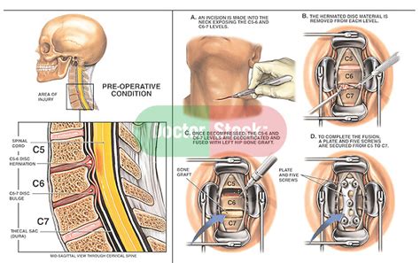 C And C Disc Herniations With Two Level Anterior Discectomy And