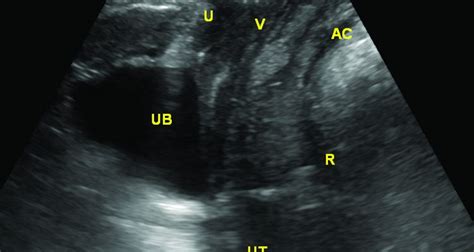 Pelvic Floor Ultrasound An Underutilised But Useful Diagnostic Tool