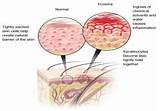 Pictures of Weeping Eczema Treatment