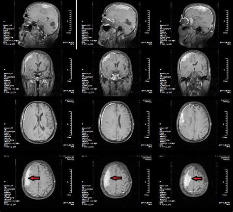 Brain Mri Obtained In Sagittal Axial And Coronal Planes On
