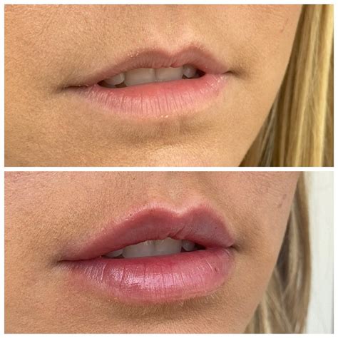 Juvederm Lips Before And After Half Syringe