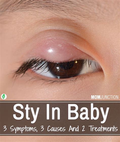 Sty In Baby 3 Symptoms 3 Causes And 2 Treatments Eyestyeproducts