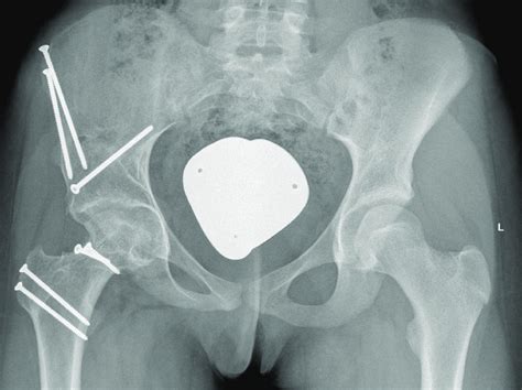 Case Two Anteroposterior Pelvic Radiograph Control 19 Months After