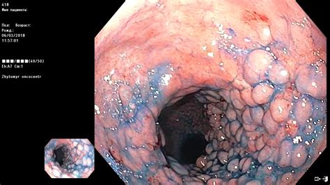 Check spelling or type a new query. Extranodal non-Hodgkin's large B-cell lymphoma. - YouTube