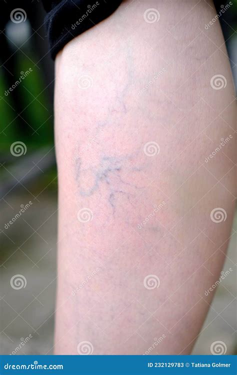 Closeup Female Leg With Blue Protruding Veins On Delicate Skin