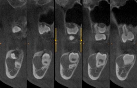 Case Of The Week Buccal Bifurcation Cyst On Cbct Dr Gs Toothpix