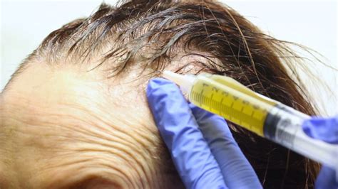 The needle or length will not affect the treatment results. PRP Hair Treatment Vancouver Cost | PRP Injection Cost