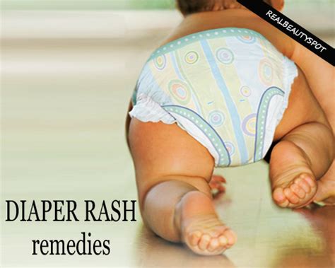 Home Remedies For Diaper Rash The Indian Spot
