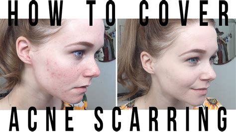 How To Cover Acne Scarring Youtube