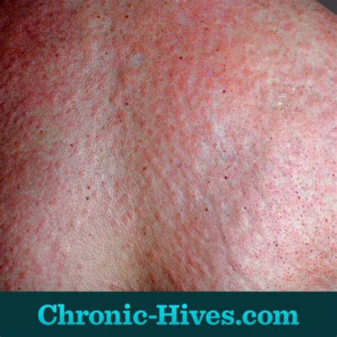 What Are Chronic Hives Geting To Know The Basics