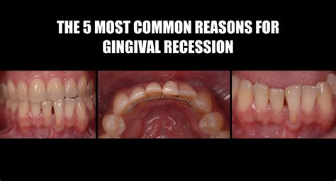 Which Are The Most Common Reasons For Gingival Recession