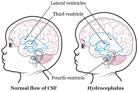 About Your Ventriculoperitoneal Vp Shunt Surgery For Pediatric