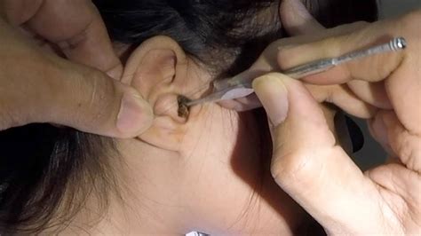 Girl S Hard Earwax Is Finally Removed Ear Fluid Got Sucked Out YouTube