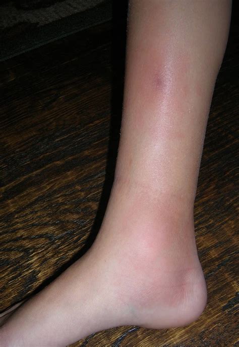 Womans Leg With Red Lumps And Swelling From Erythema Nodosum Hospital