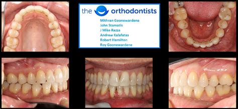 Attempting to straighten your own teeth can cause pain or unwanted shifting. Invisalign - Before and After Photos (Australia 2019)