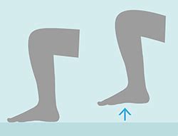 Es besteht dabei die gefahr, dass gerinnselteile aus dem bein bis in die lunge rasen und dort blutgefäße. Thrombose vorbeugen - Diese Tipps helfen