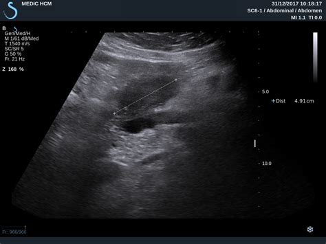 Vietnamese Medic Ultrasound Case 471 Mesenteric Lymphoma Dr Phan