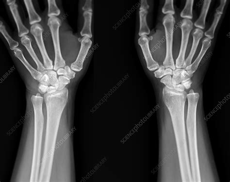 Healthy Wrists X Ray Stock Image F0375548 Science Photo Library