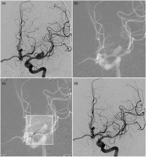 A Angiography Of Left Internal Carotid Artery Shows An Aneurysm