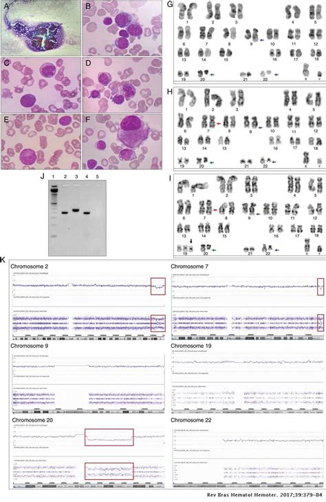 Acute Myeloid Leukemia With E1a2 Bcr Abl1 Fusion Gene Two Cases With