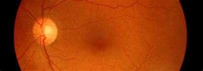 Fundus Eye Patient Imaging Ophthalmology Pupil Visual