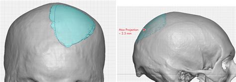 Plastic Surgery Case Study Small Custom Occipital Skull Implant