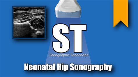 Neonatal Hip Ultrasound Sonographic Tendencies
