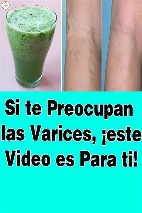 Pin En Remedio Para Las Varices